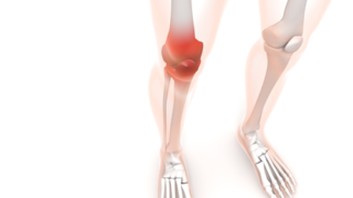 変形性膝関節症,原因,筋力低下
