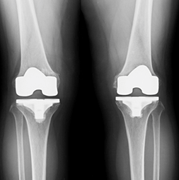 変形性膝関節症,人工関節,手術